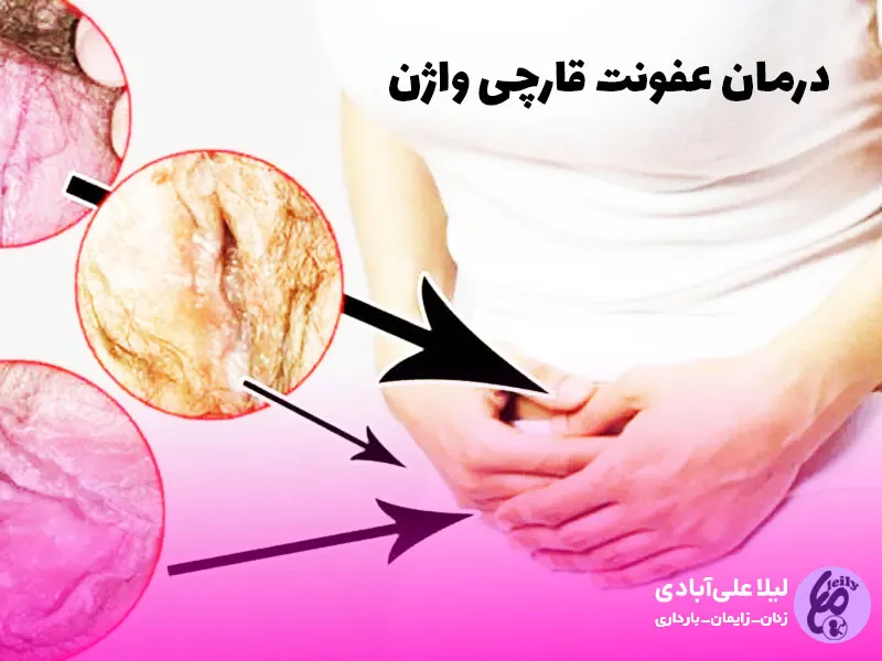 پماد برای عفونت مخمری واژن