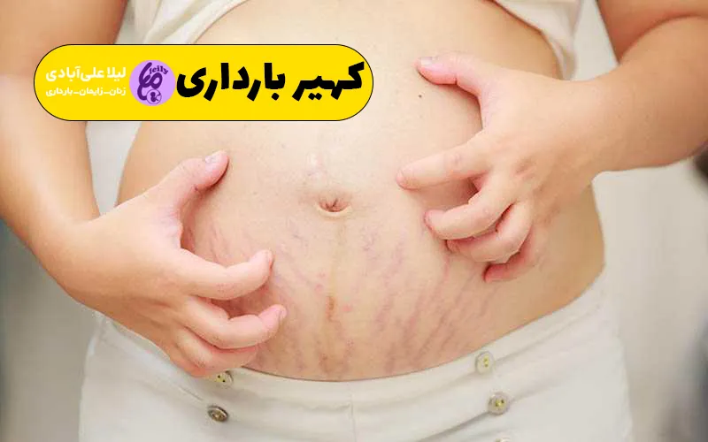 کهیر بارداری