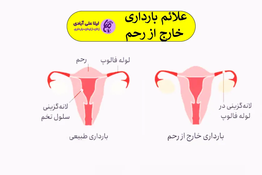 بارداری خارج از رحم
