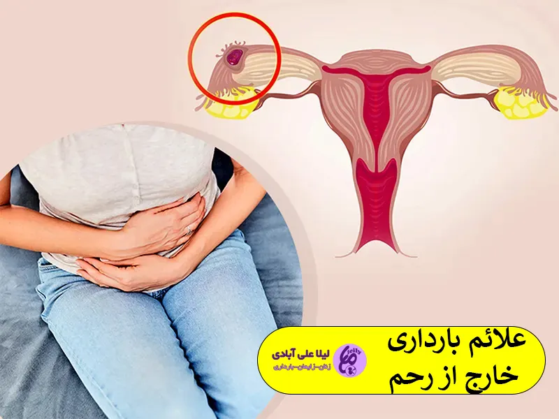 بارداری خارج از رحم