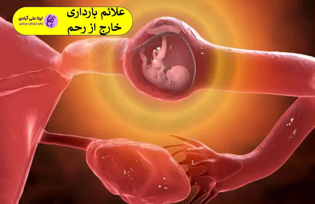 بارداری خارج از رحم