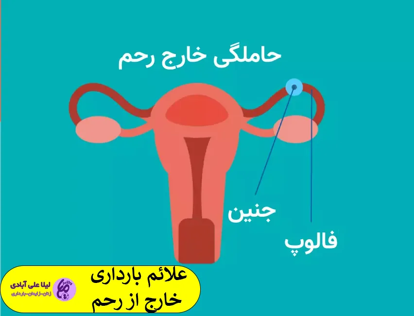 بارداری خارج از رحم