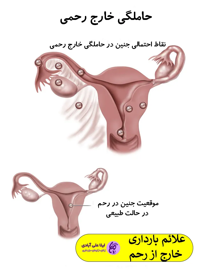 بارداری خارج از رحم