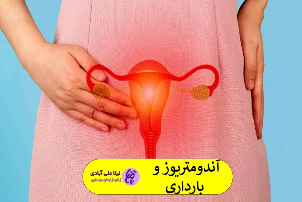 آندومتریوز و بارداری