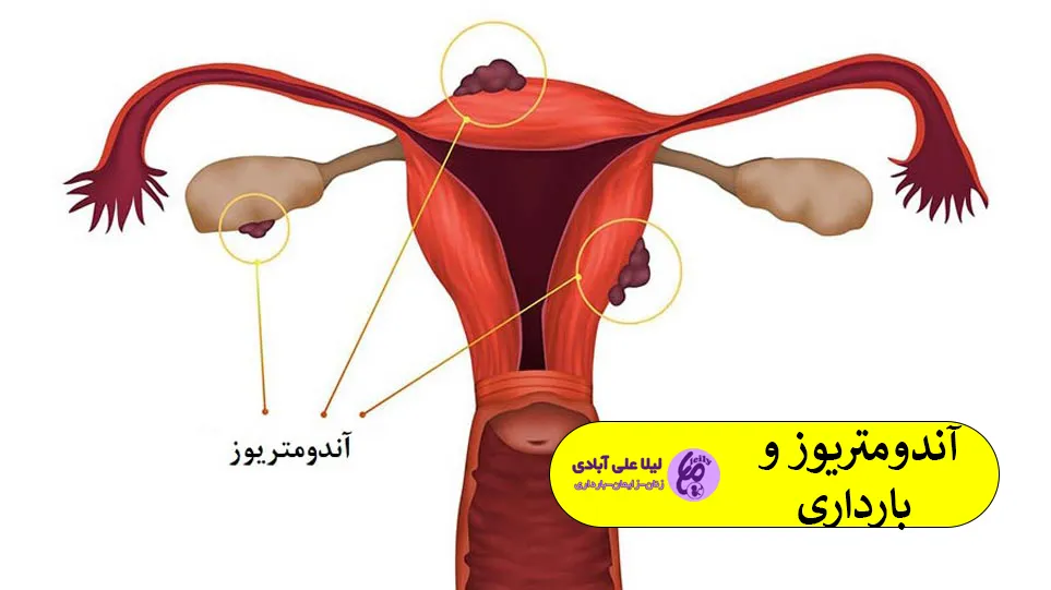آندومتریوز و بارداری