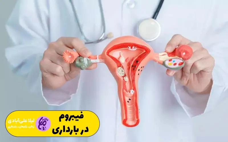 فیبروم در بارداری