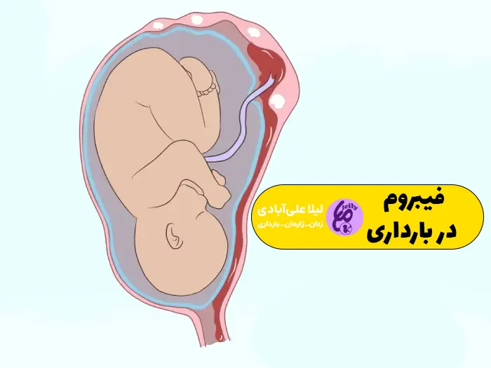 فیبروم در بارداری