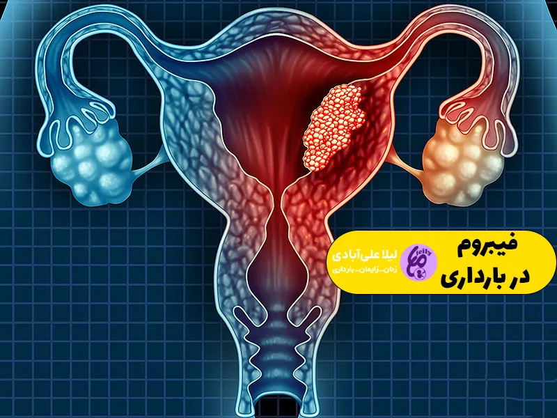 فیبروم در بارداری