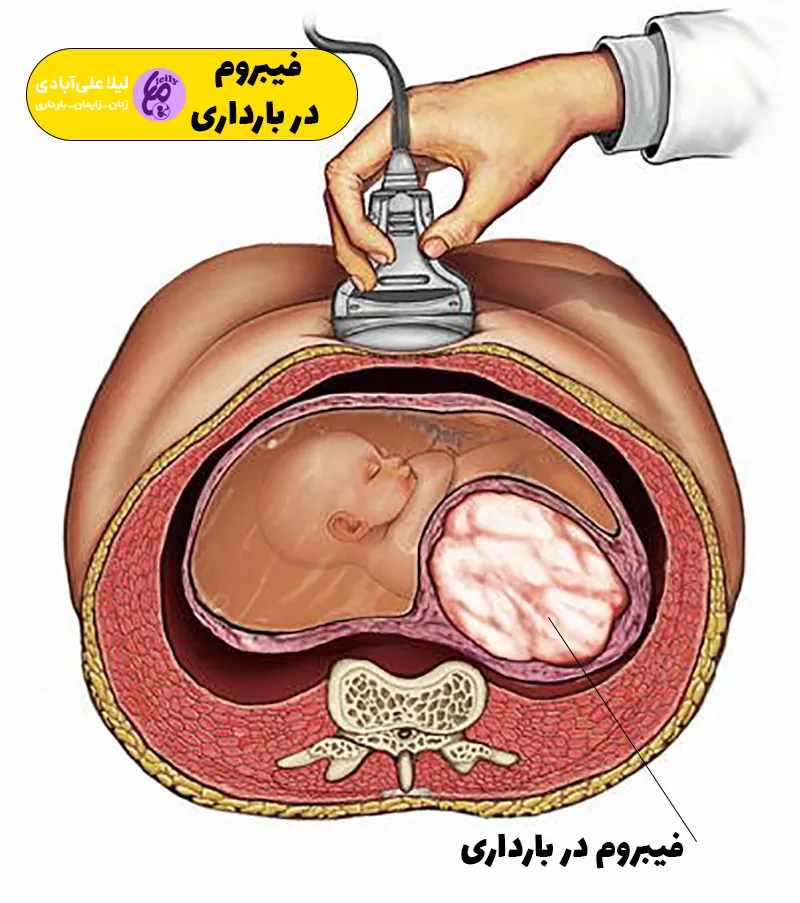 فیبروم در بارداری