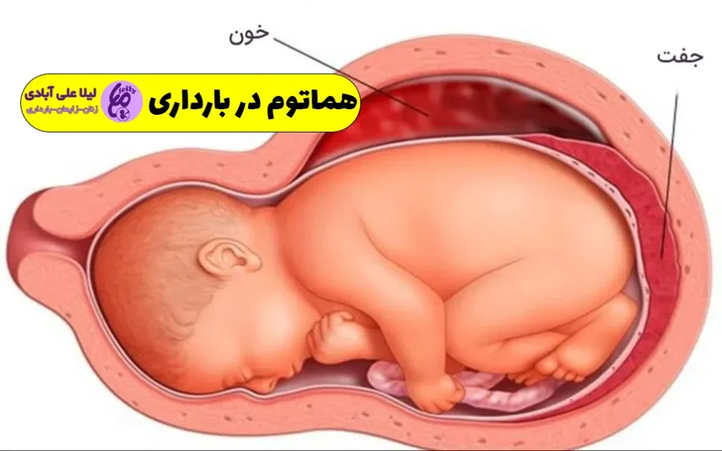 هماتوم در بارداری