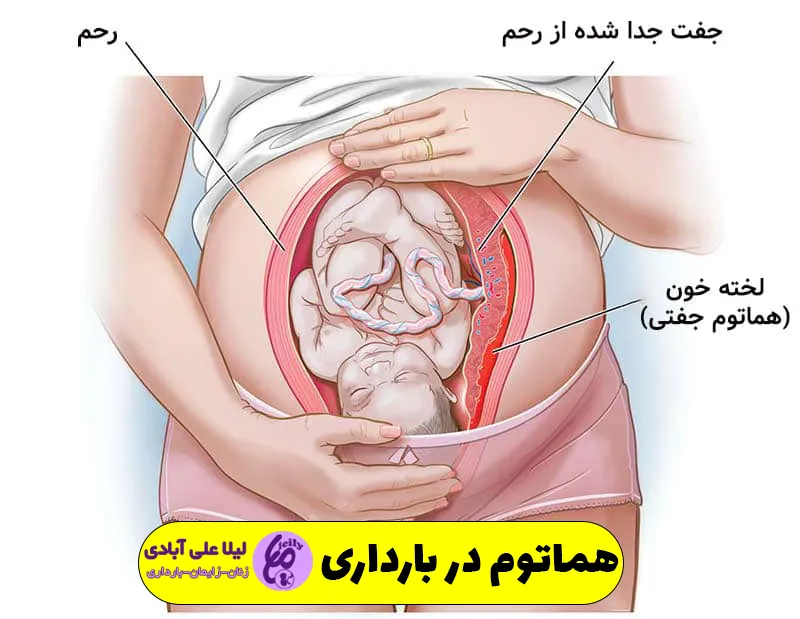هماتوم در بارداری