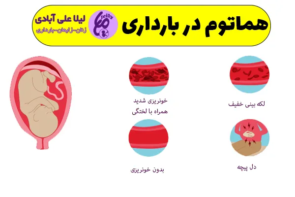 هماتوم در بارداری