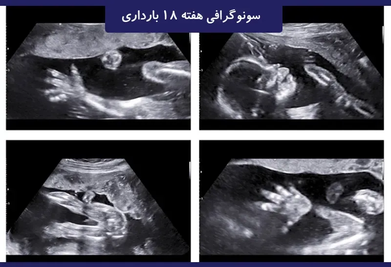 هفته هجدهم بارداری