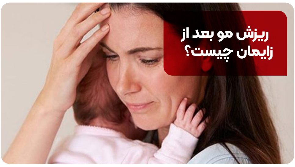 ریزش مو بعد از زایمان