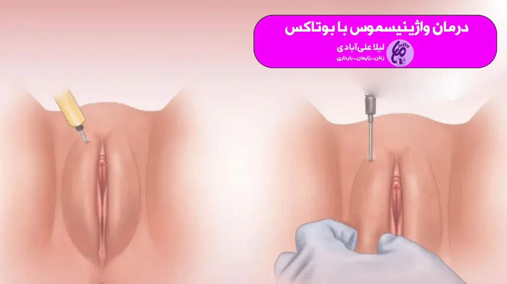 درمان واژینیسموس با بوتاکس