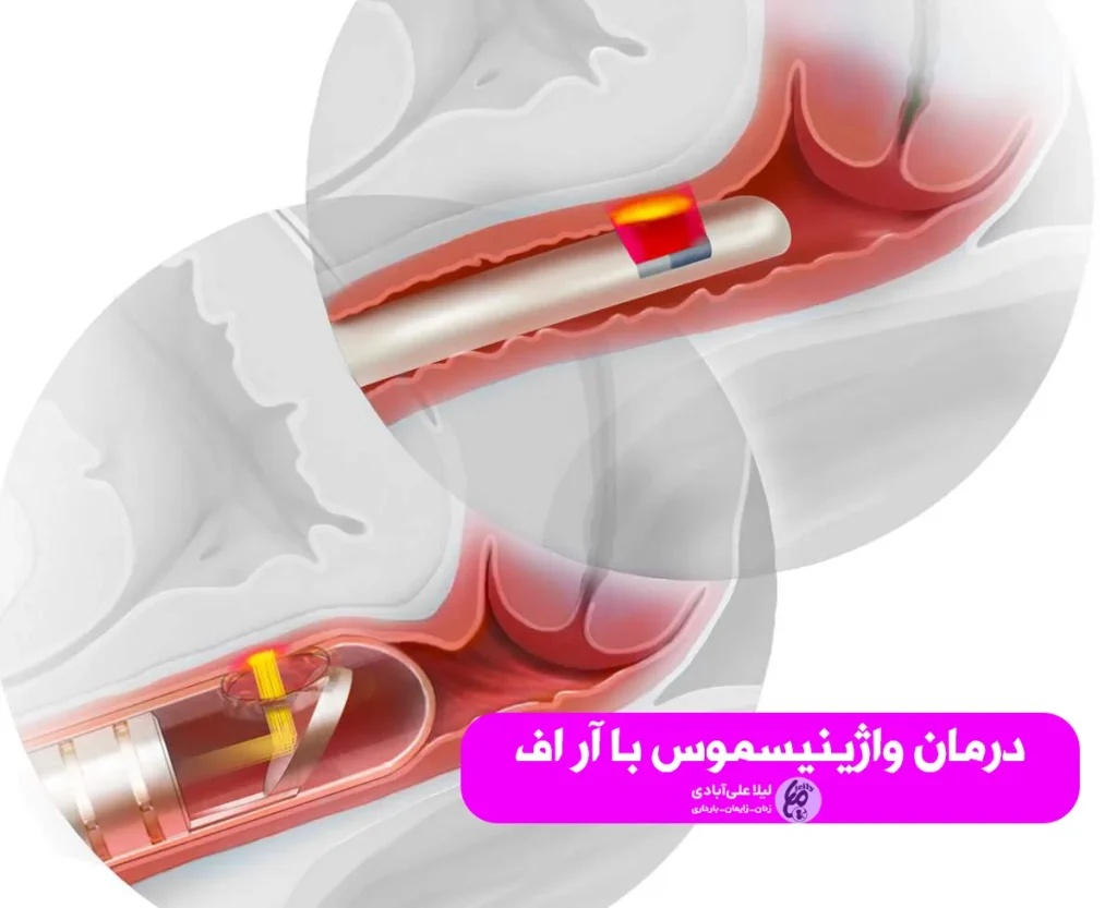 درمان واژینیسموس با آر اف