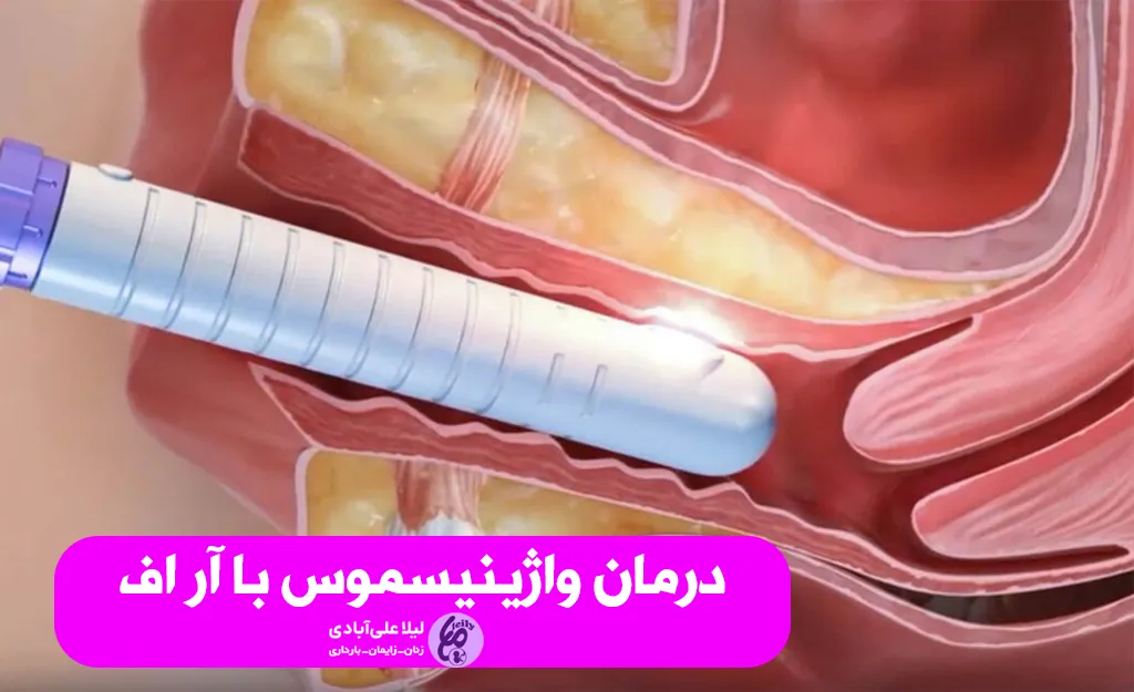 درمان واژینیسموس با آر اف