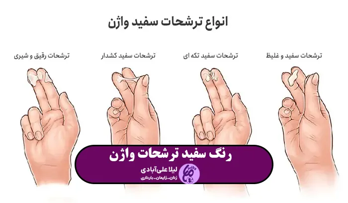 ترشحات سفید واژن