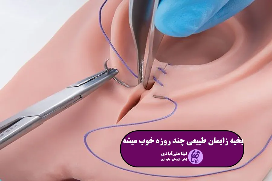 بخیه زایمان طبیعی چند روزه خوب میشه