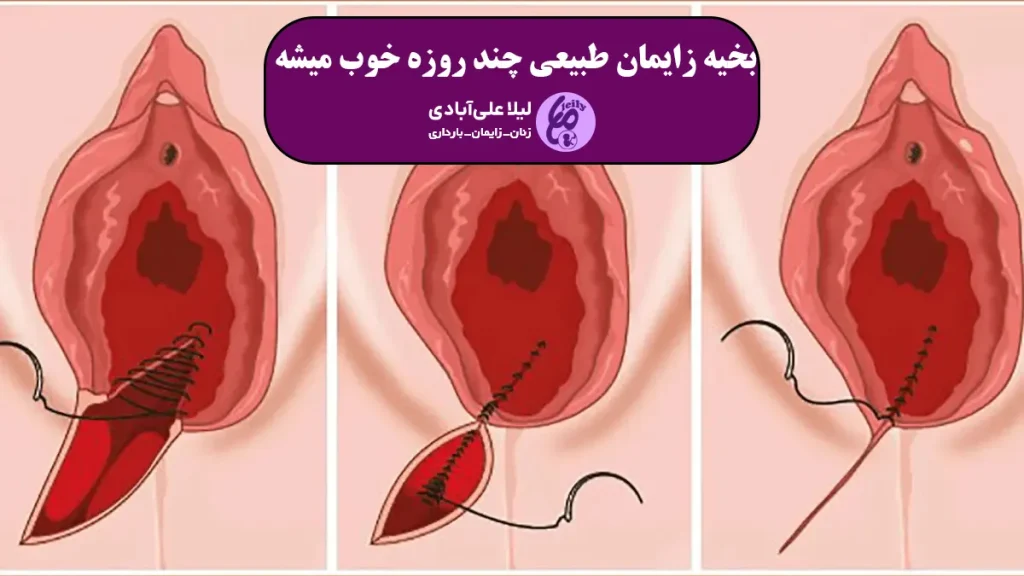 بخیه زایمان طبیعی چند روزه خوب میشه