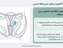 جا ماندن کاندوم در واژن حین رابطه جنسی