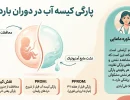 پارگی کیسه آب در بارداری